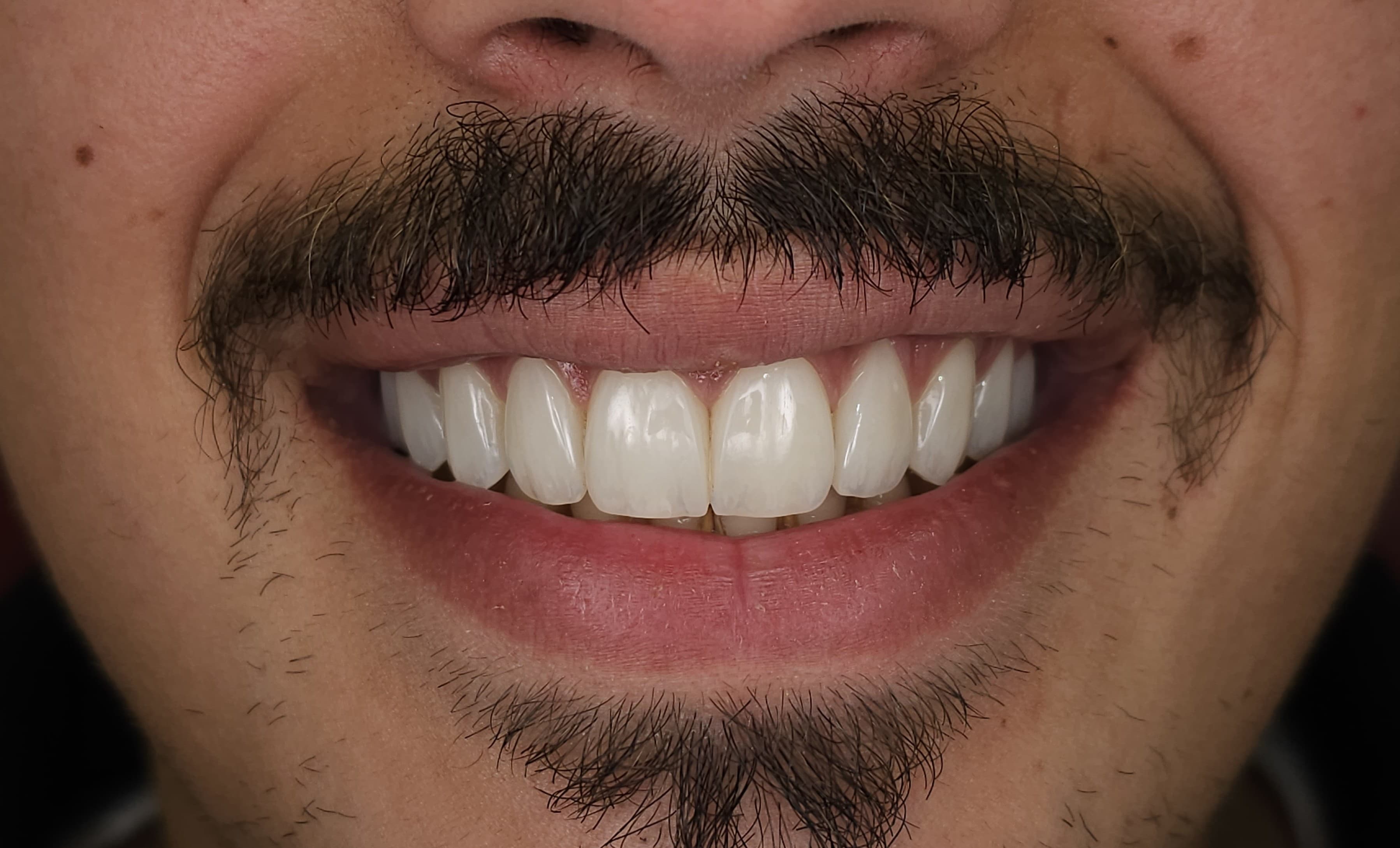 Anterior Veneers, Final Result