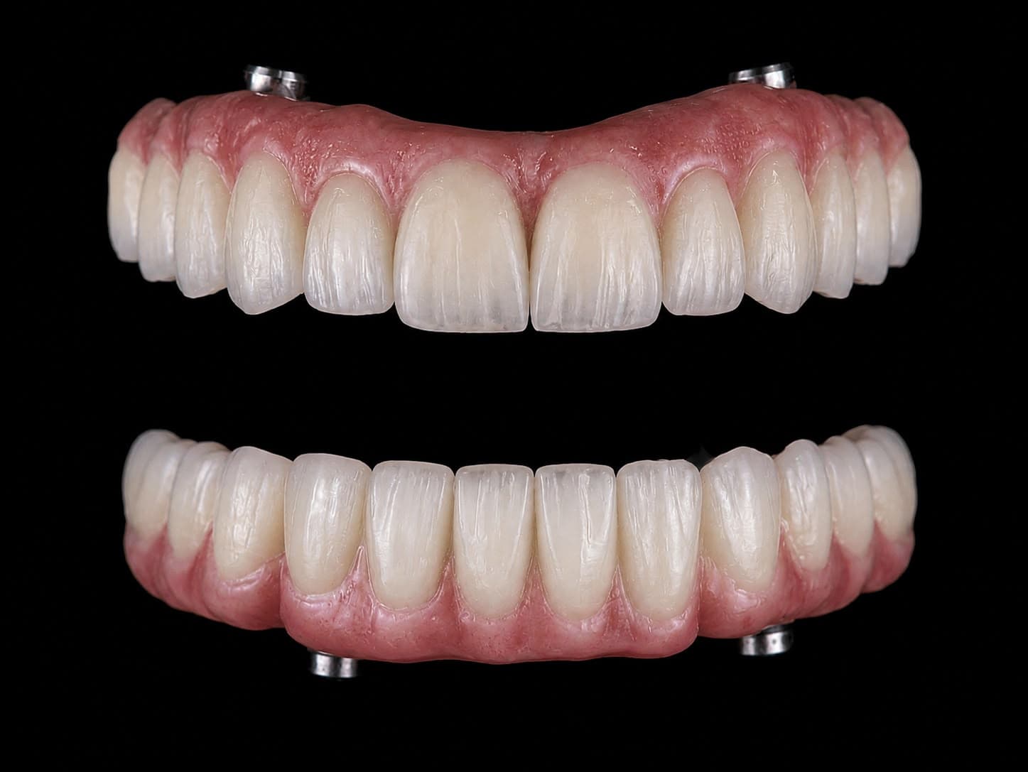 Full-Arch Implant-Supported Prosthesis