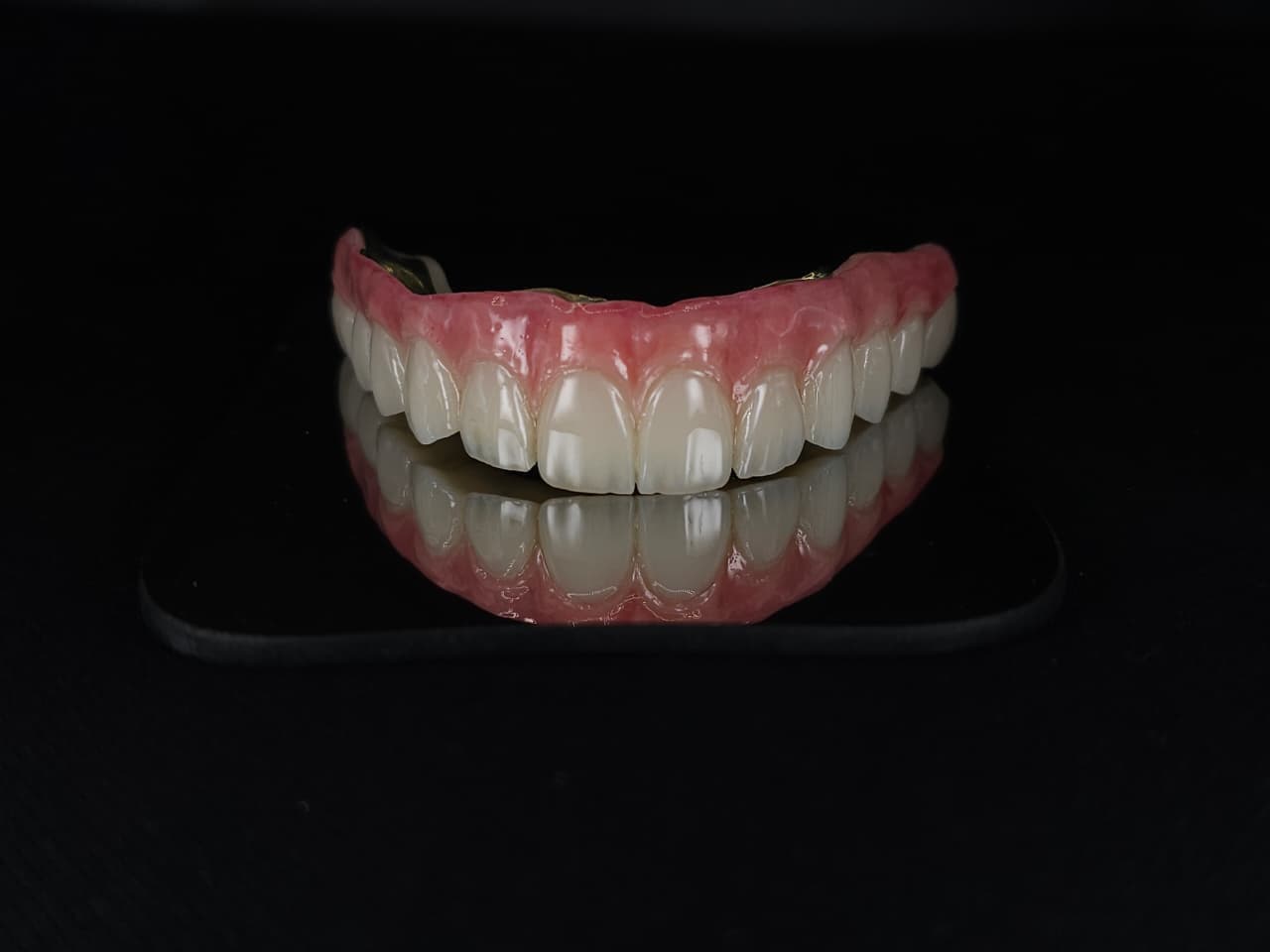Implant-Supported Anterior Bridge with Gingival Ceramic