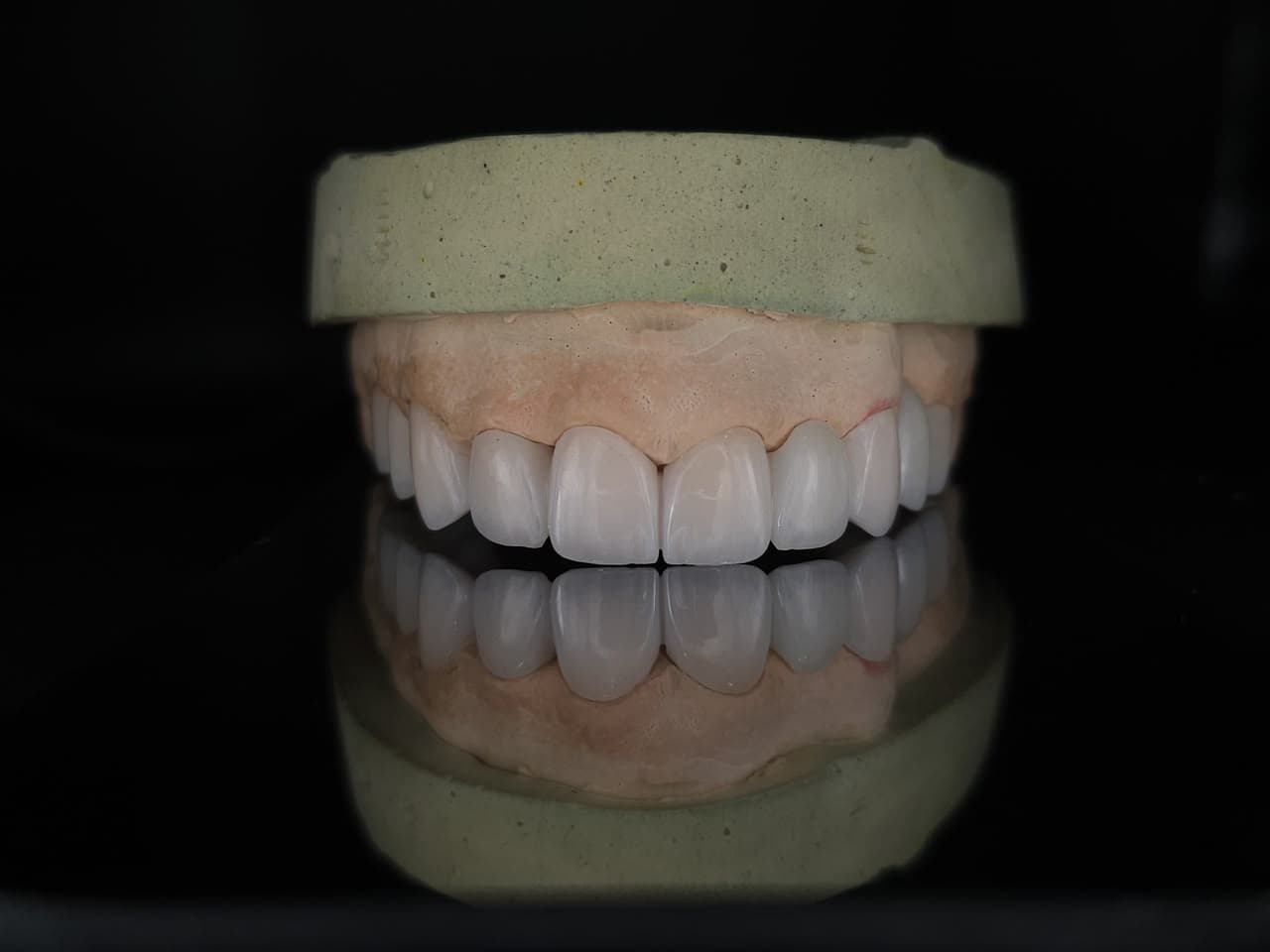 Anterior Crowns/Veneers on Master Model