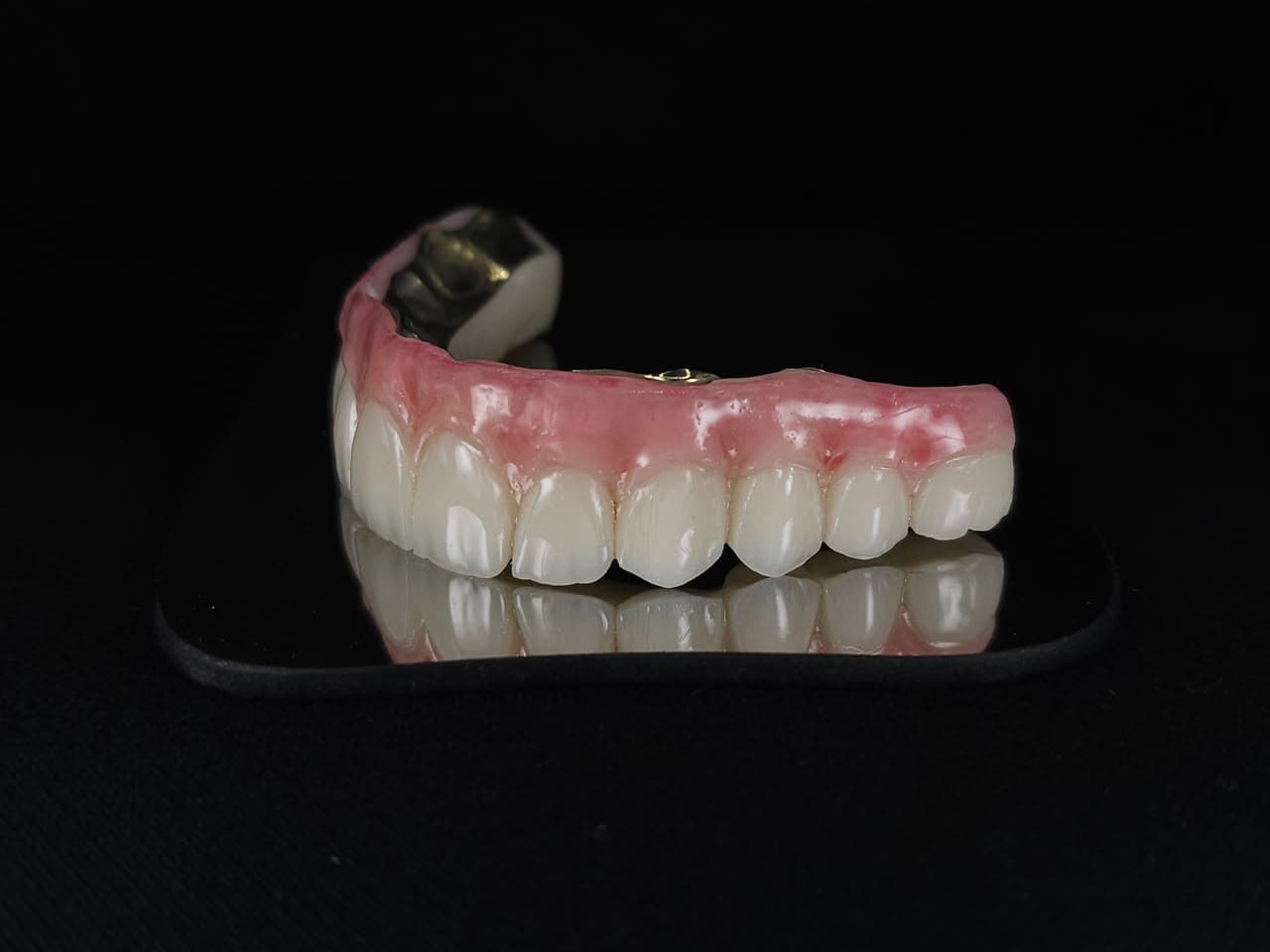 Full-Arch Implant Bridge