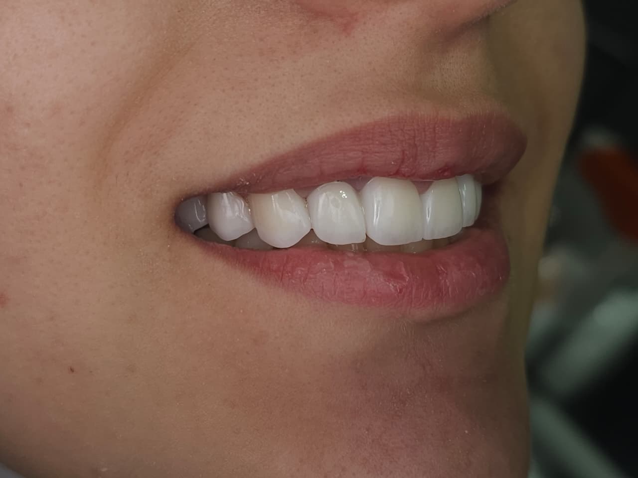 Final Clinical Result